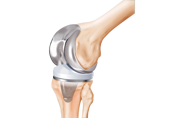 Usiner les composants orthopédiques, selon Seco